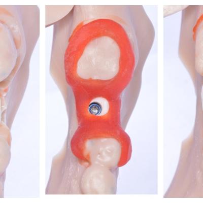 Protezuvannia Na Implantakh V17 I6