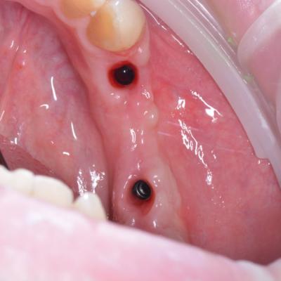 Protezuvannia Na Implantakh V18 I1