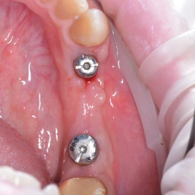 Protezuvannia Na Implantakh V18 I2