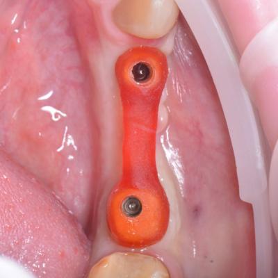 Protezuvannia Na Implantakh V18 I3