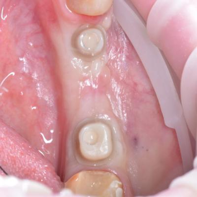 Protezuvannia Na Implantakh V18 I4