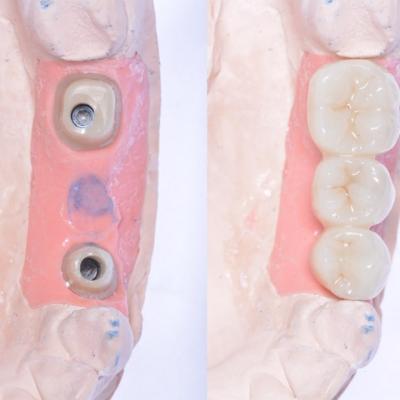 Protezuvannia Na Implantakh V18 I5