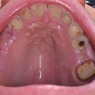 Protezuvannia Na Zubakh Ta Implantakh V001 001