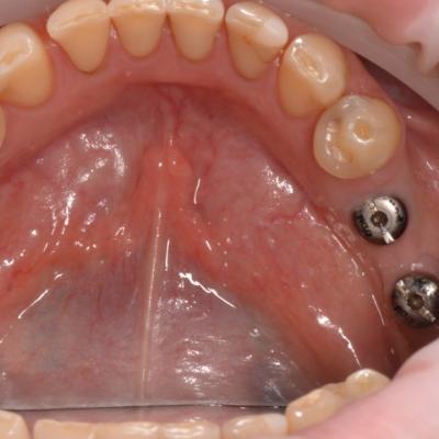 Protezuvannia Na Implantakh V002 001