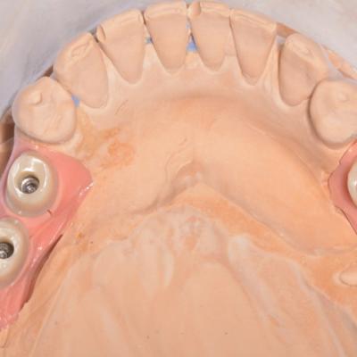 Protezuvannia Na Implantakh V002 002
