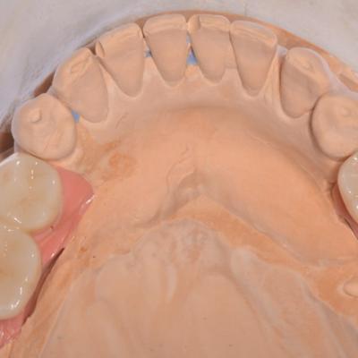 Protezuvannia Na Implantakh V002 003