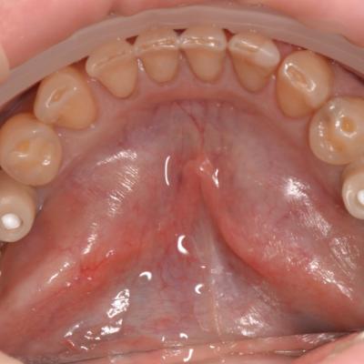 Protezuvannia Na Implantakh V002 004