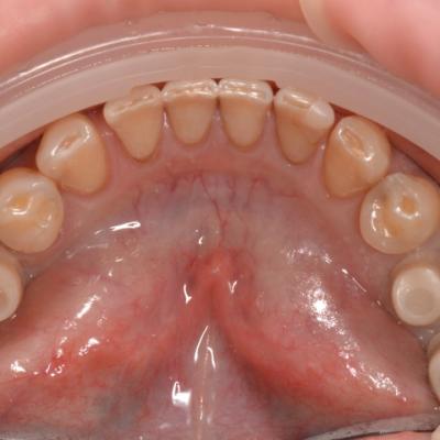 Protezuvannia Na Implantakh V002 005