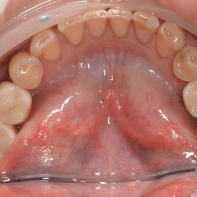 Protezuvannia Na Implantakh V002 006