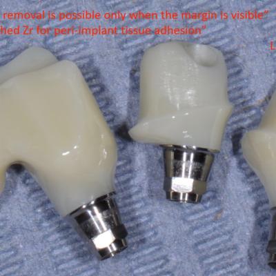 Protezuvannia Na Zubakh Ta Implantakh V002 001