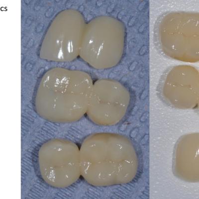 Protezuvannia Na Zubakh Ta Implantakh V002 002