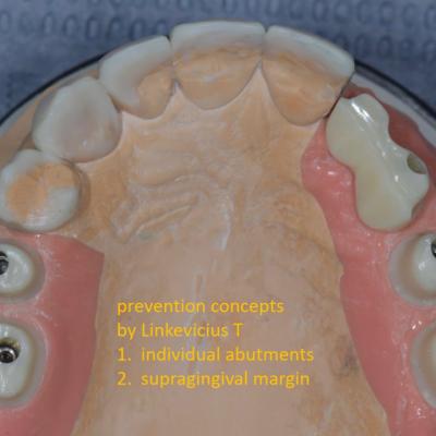 Protezuvannia Na Zubakh Ta Implantakh V002 003