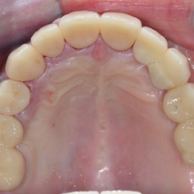 Protezuvannia Na Zubakh Ta Implantakh V002 004