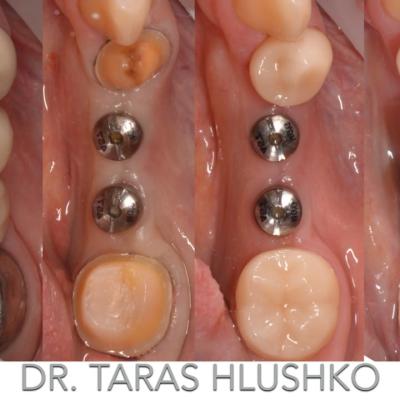 Protezuvannia Na Zubakh Ta Implantakh V003 001