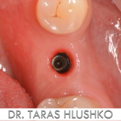 Protezuvannia Na Implantakh V003 002