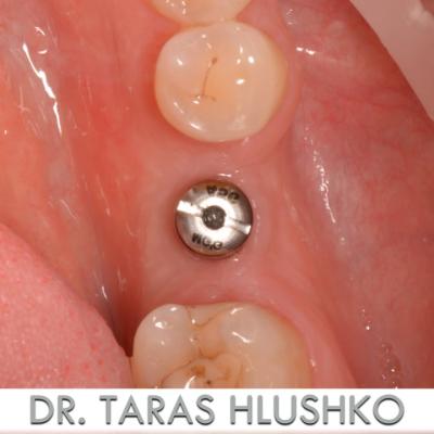 Protezuvannia Na Implantakh V003 003