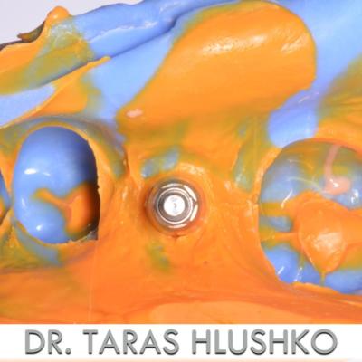 Protezuvannia Na Implantakh V003 004