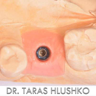 Protezuvannia Na Implantakh V003 005