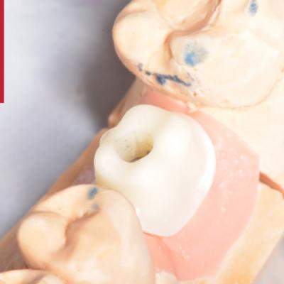 Protezuvannia Na Implantakh V003 006