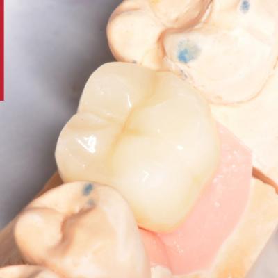 Protezuvannia Na Implantakh V003 007