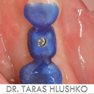 Protezuvannia Na Implantakh V003 008