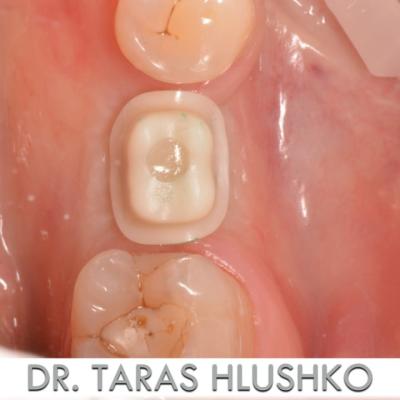 Protezuvannia Na Implantakh V003 009