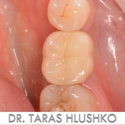 Protezuvannia Na Implantakh V003 010